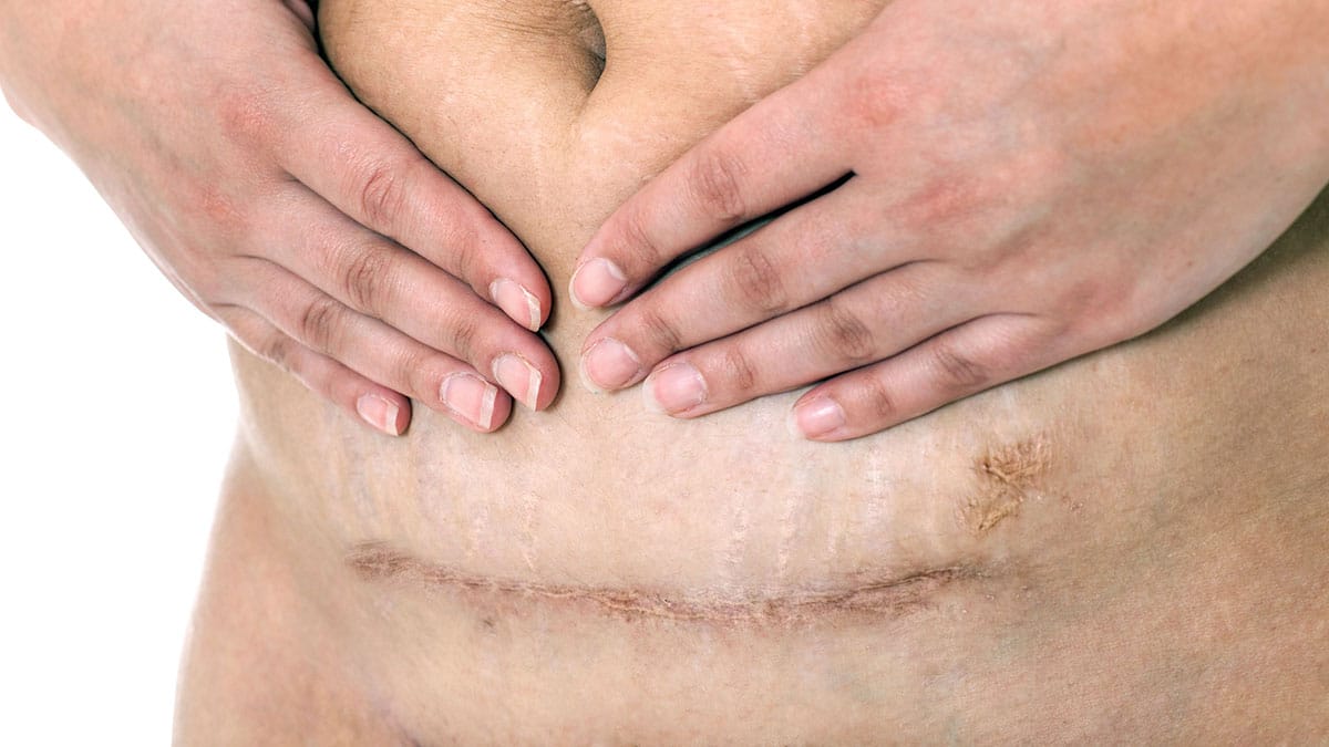 woman holding her stomach above her C-section scar