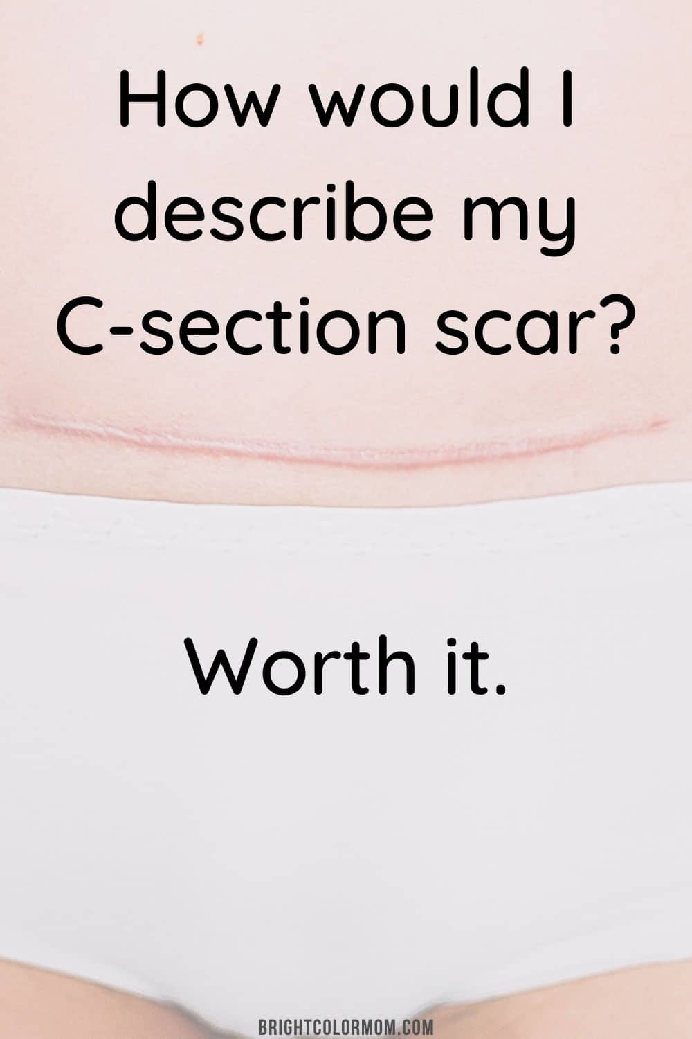 How would I describe my C-section scar? Worth it.